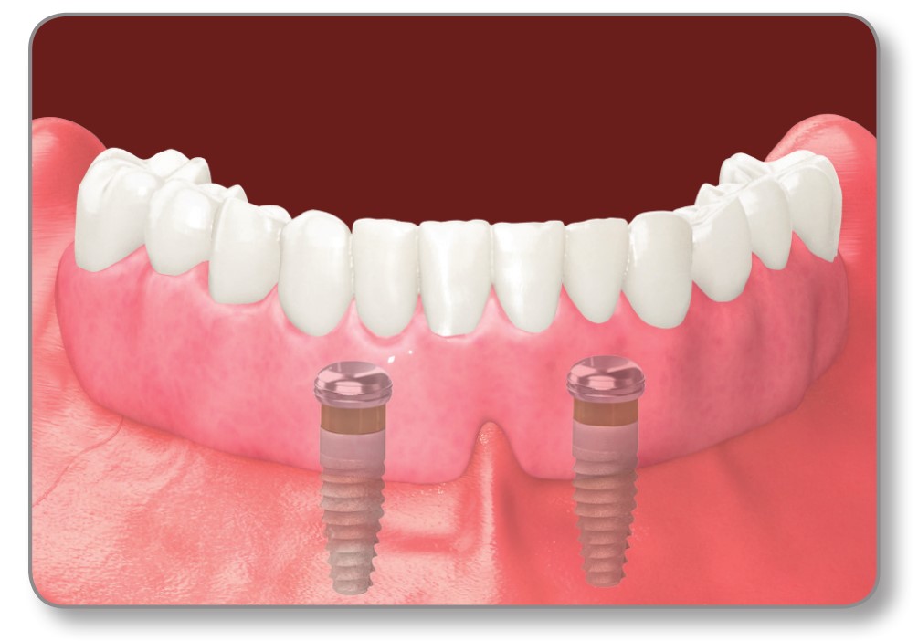 Immediate Dentures Day 1 Baldwin MI 49304